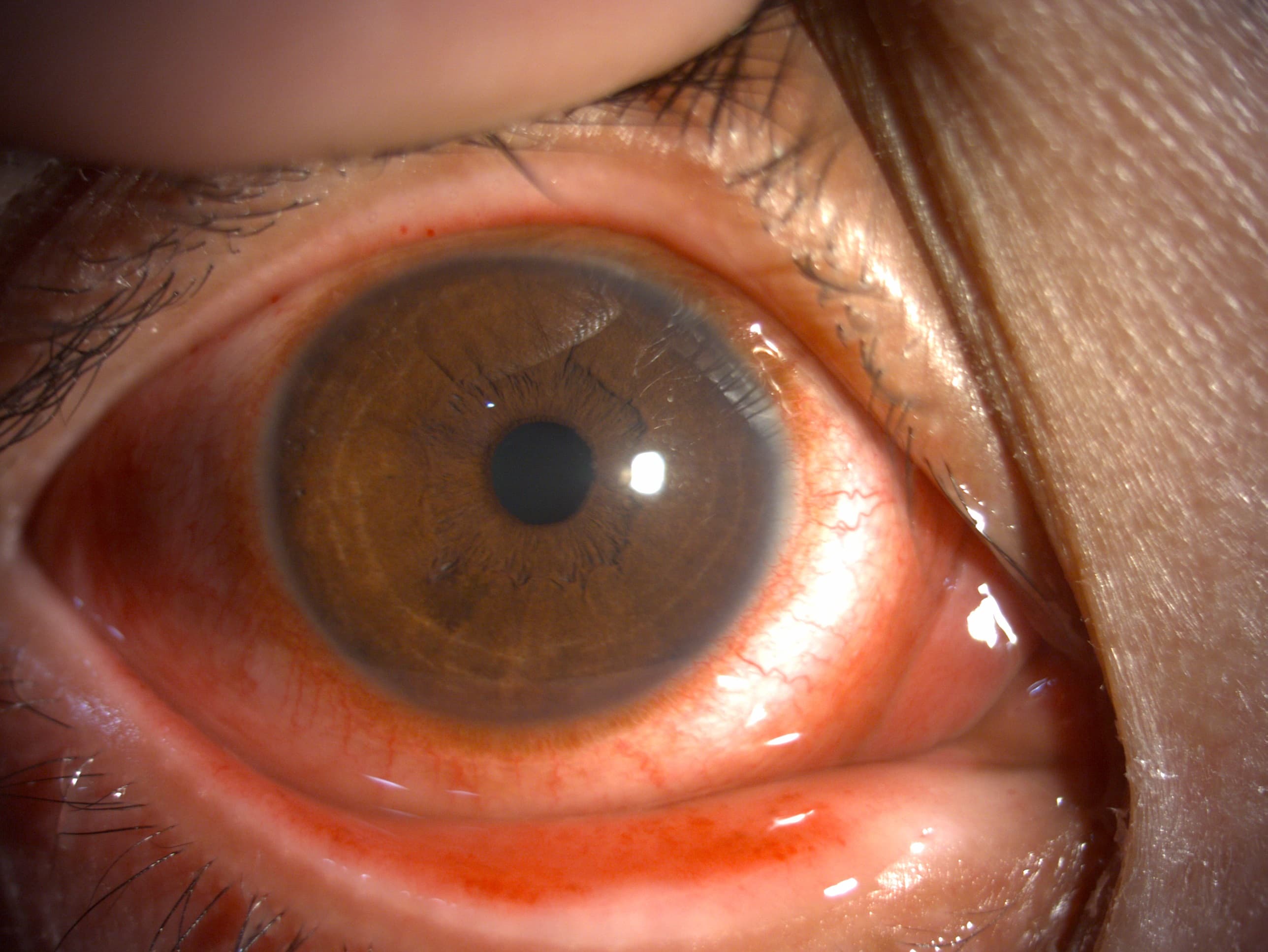 急性結膜炎症狀：高陽明眼科診所